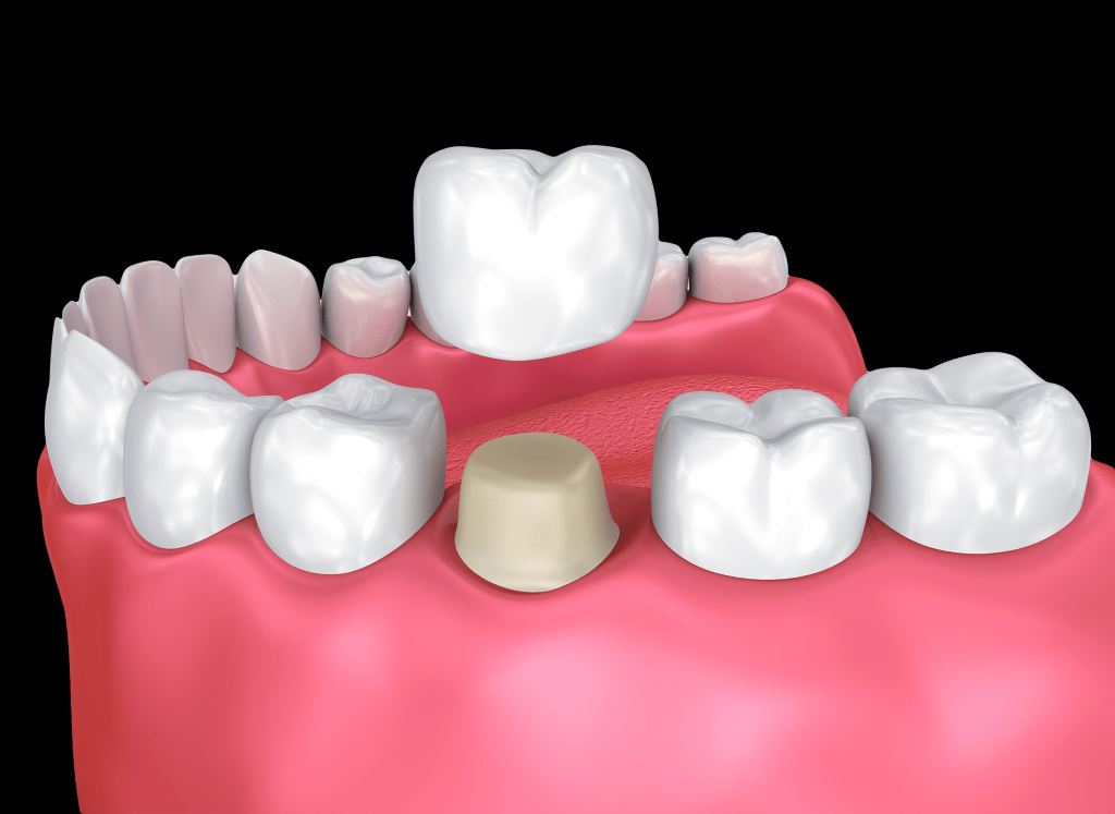dental crowns burlington