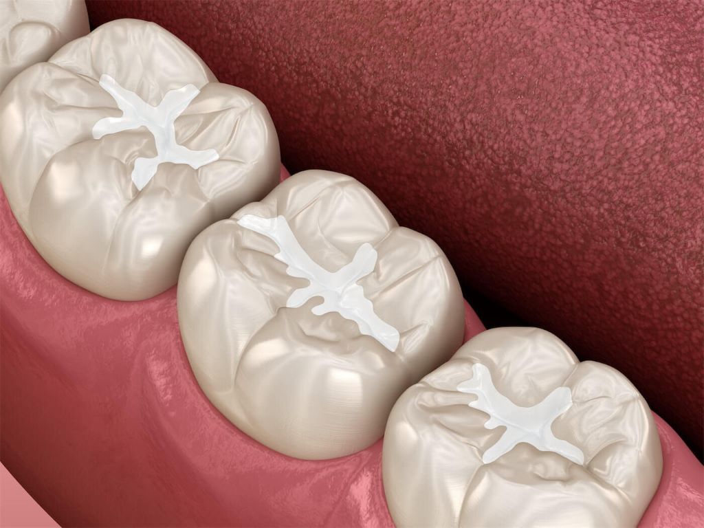 dental fillings in burlington