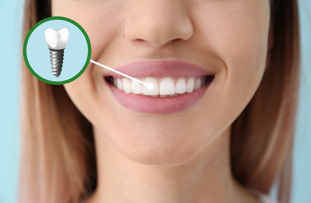 dental implants in burlington