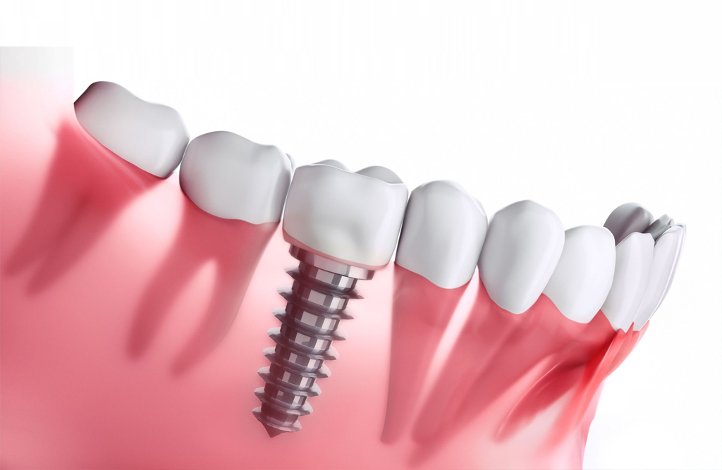 dental implants near you in burlington