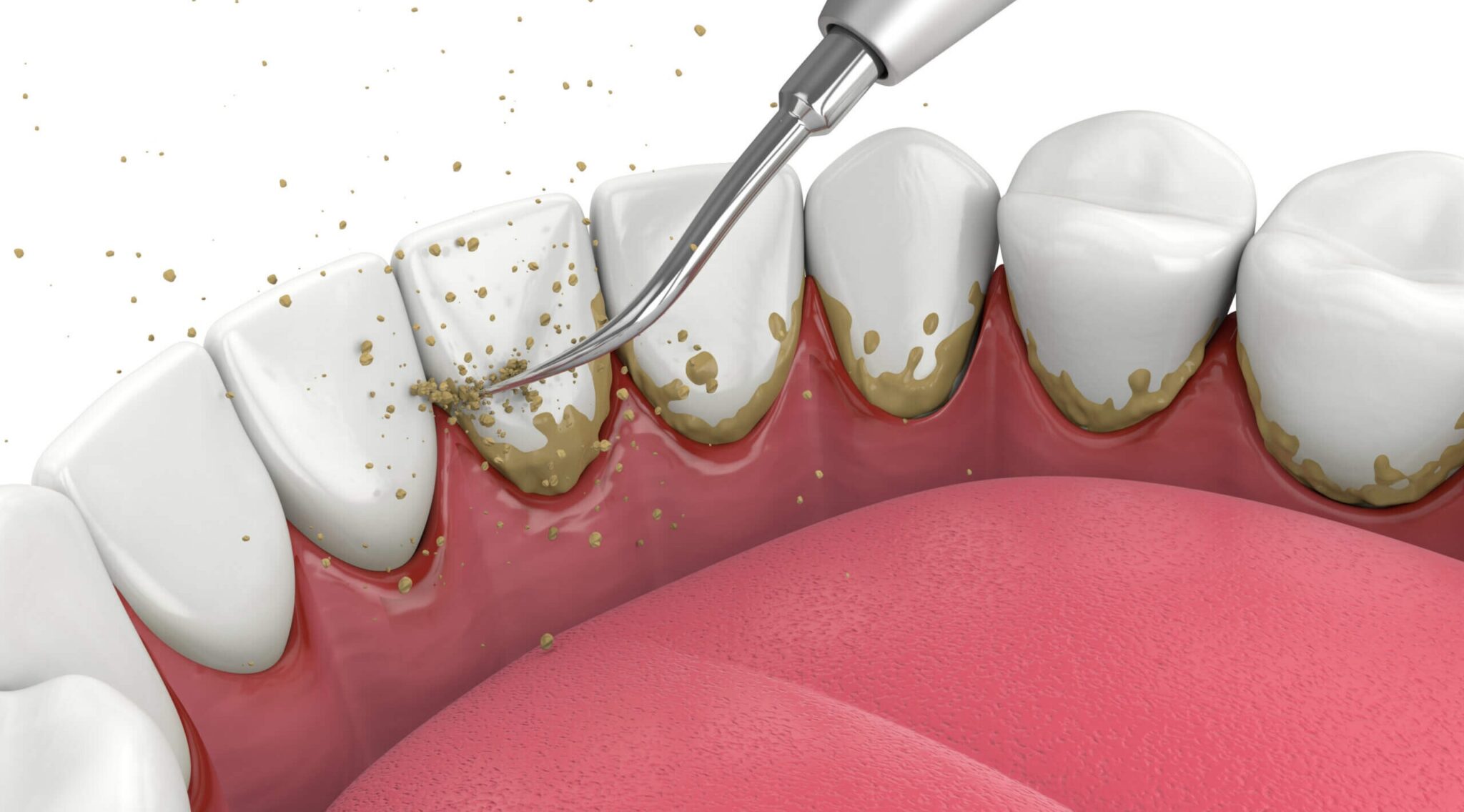 periodontal therapy burlington