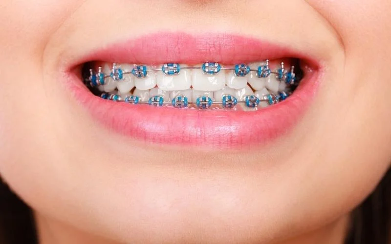 conventional braces burlington