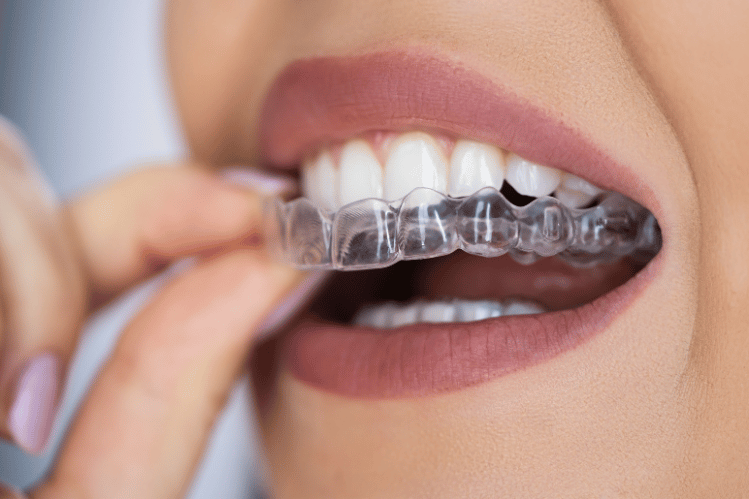 invisalign in burlington