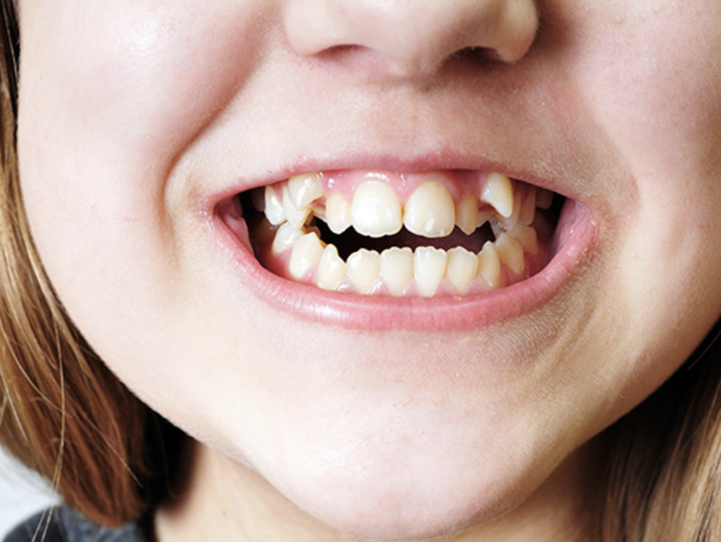 orofacial myology in burlington