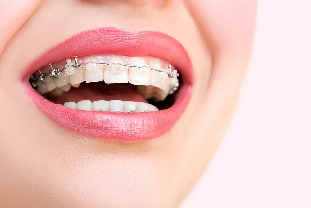 self ligating braces burlington