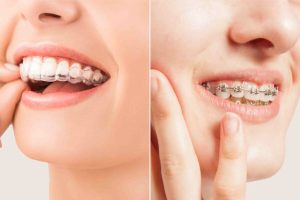 clear aligners vs braces which is best for adults